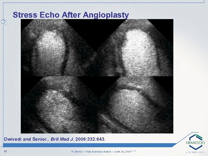 Stress Echo After Angioplasty Dwivedi and Senior. . Brit Med J. 2006: 332: 643.