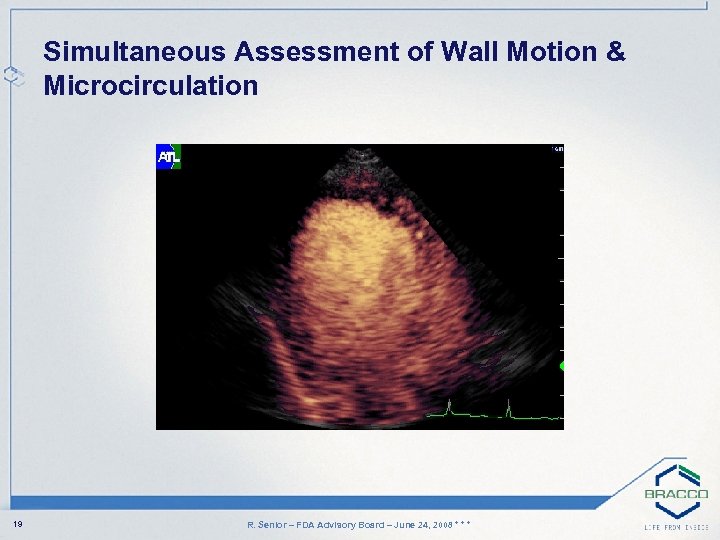 Simultaneous Assessment of Wall Motion & Microcirculation 19 R. Senior – FDA Advisory Board