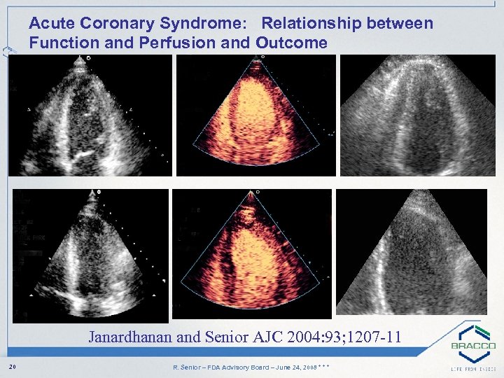 Acute Coronary Syndrome: Relationship between Function and Perfusion and Outcome Janardhanan and Senior AJC