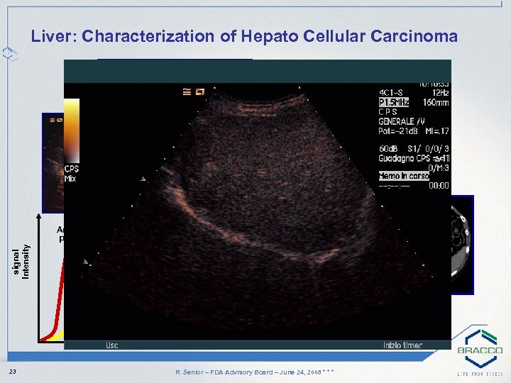 signal Intensity Liver: Characterization of Hepato Cellular Carcinoma Arterial Phase Portal Phase Late Phase