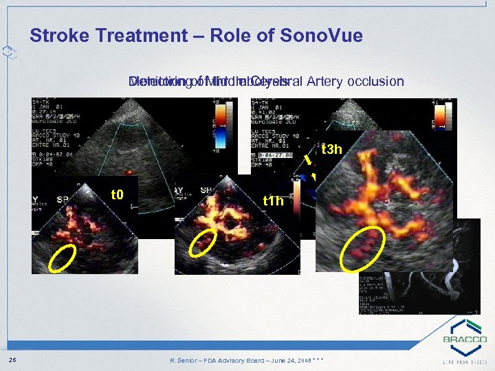 Stroke Treatment – Role of Sono. Vue Monitoring of thrombolysis Detection of Middle Cerebral