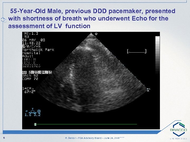 55 -Year-Old Male, previous DDD pacemaker, presented with shortness of breath who underwent Echo