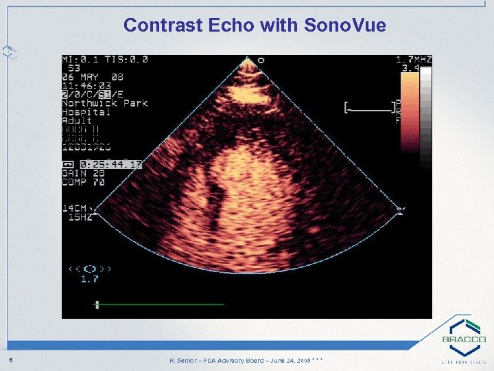 Contrast Echo with Sono. Vue 6 R. Senior – FDA Advisory Board – June