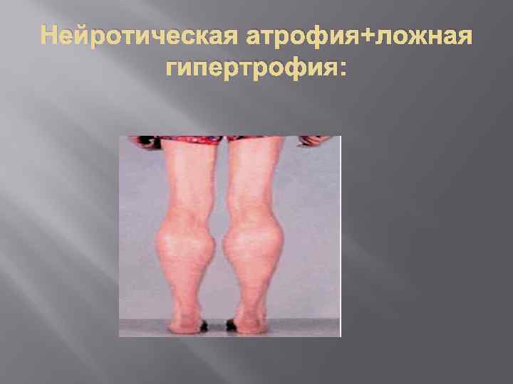 Нейротическая атрофия+ложная гипертрофия: 