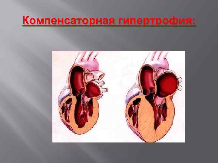 Компенсаторная гипертрофия: 