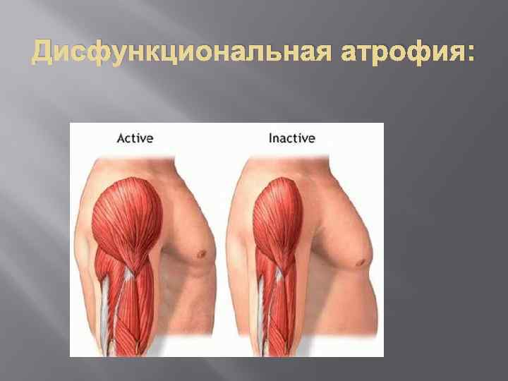 Дисфункциональная атрофия: 