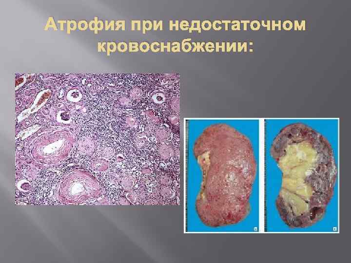 Атрофия при недостаточном кровоснабжении: 