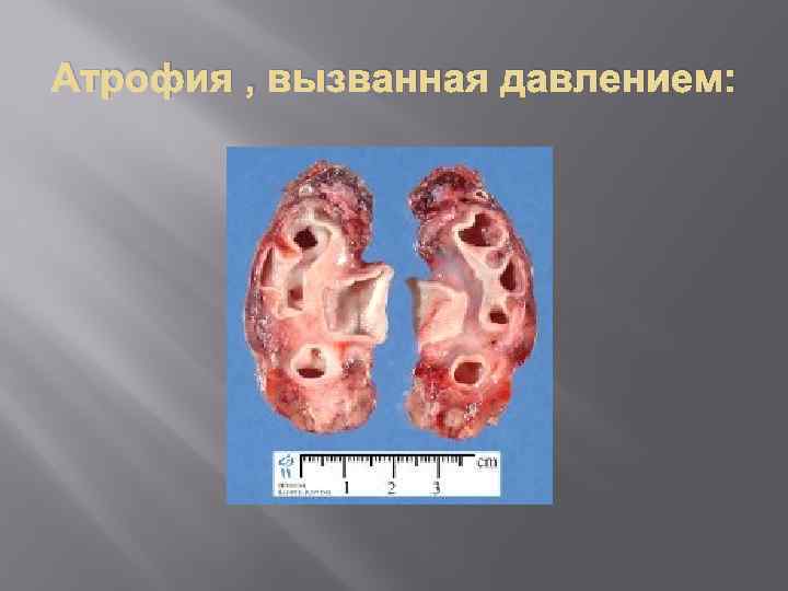 Атрофия , вызванная давлением: 