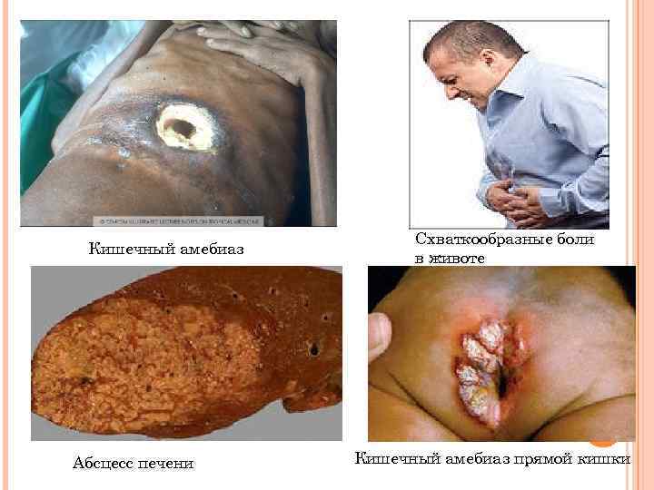 Кишечный амебиаз Абсцесс печени Схваткообразные боли в животе Кишечный амебиаз прямой кишки 