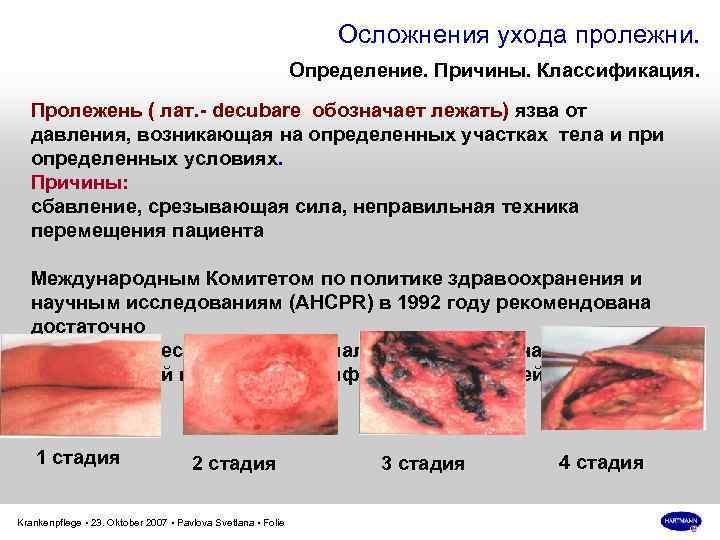Осложнения ухода пролежни. Определение. Причины. Классификация. Пролежень ( лат. - decubare обозначает лежать) язва