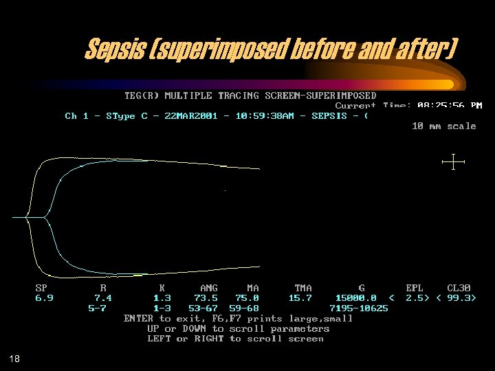 Sepsis (superimposed before and after) 18 
