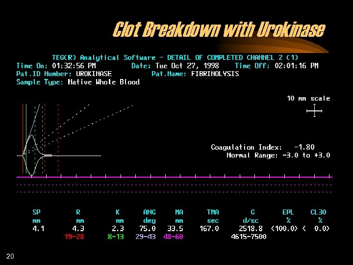 Clot Breakdown with Urokinase 20 