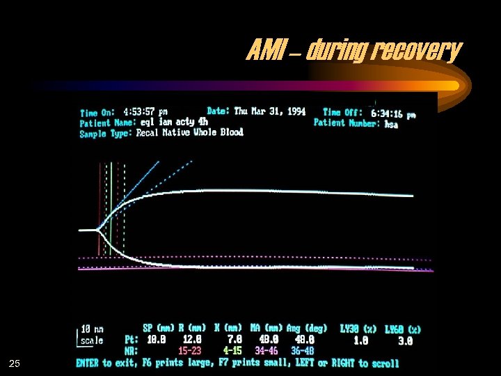 AMI – during recovery 25 