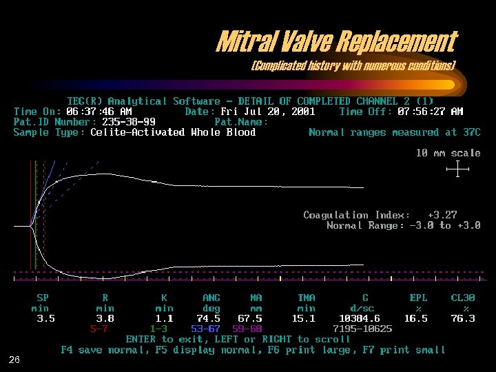 Mitral Valve Replacement (Complicated history with numerous conditions) 26 