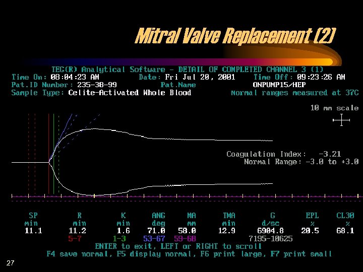 Mitral Valve Replacement (2) 27 