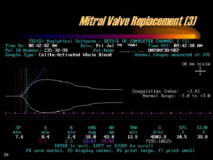 Mitral Valve Replacement (3) 28 