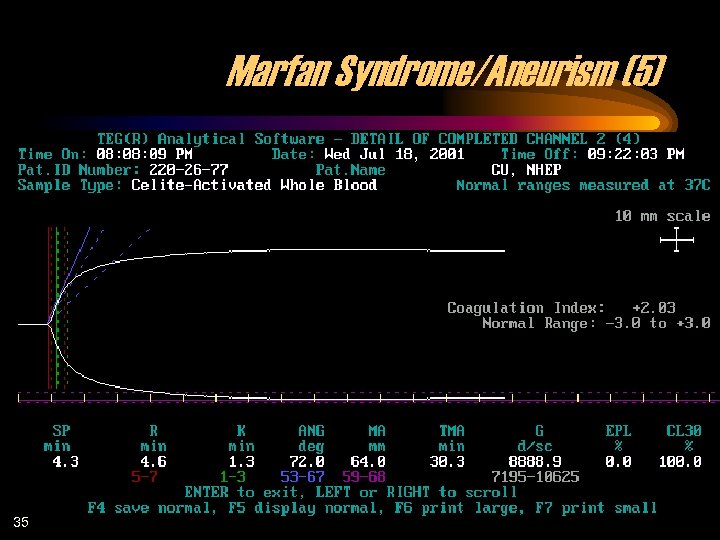 Marfan Syndrome/Aneurism (5) 35 