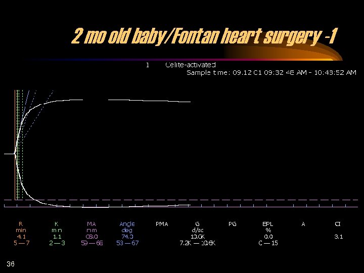 2 mo old baby/Fontan heart surgery -1 36 