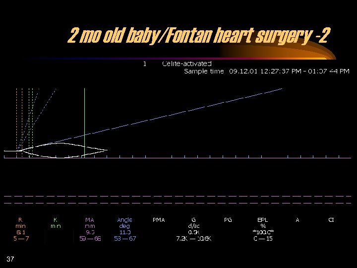2 mo old baby/Fontan heart surgery -2 37 