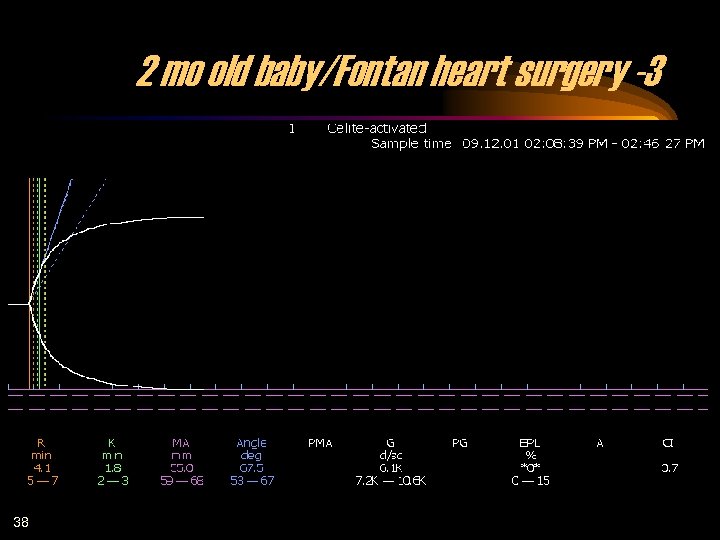 2 mo old baby/Fontan heart surgery -3 38 