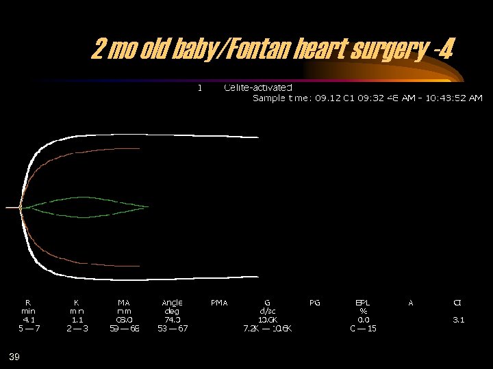 2 mo old baby/Fontan heart surgery -4 39 