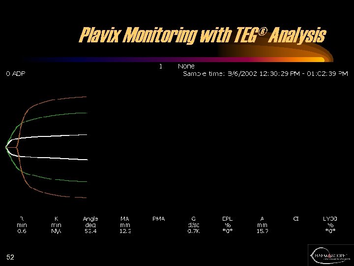 Plavix Monitoring with TEG® Analysis 52 