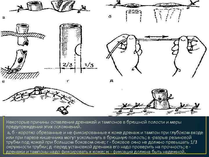 Некоторые причины оставления дренажей и тампонов в брюшной полости и меры предупреждения этих осложнений.