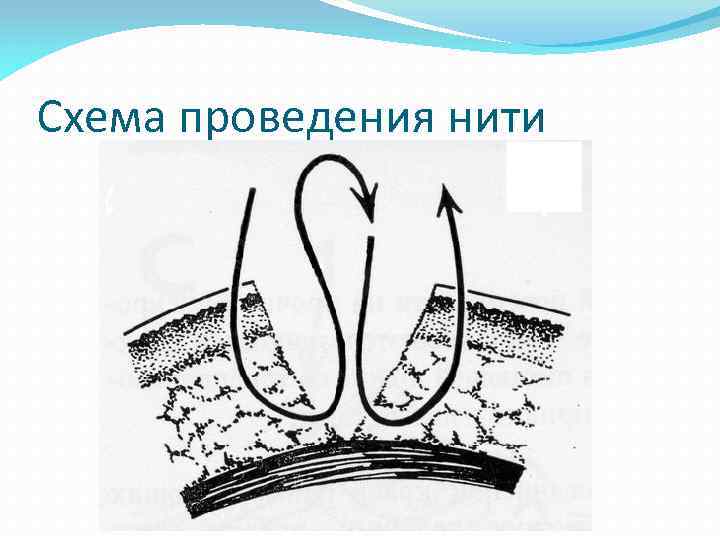 Схема проведения нити 