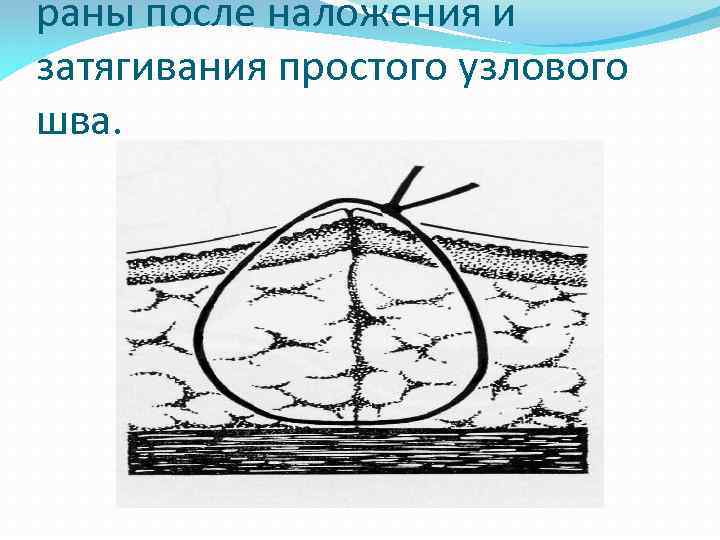 раны после наложения и затягивания простого узлового шва. 