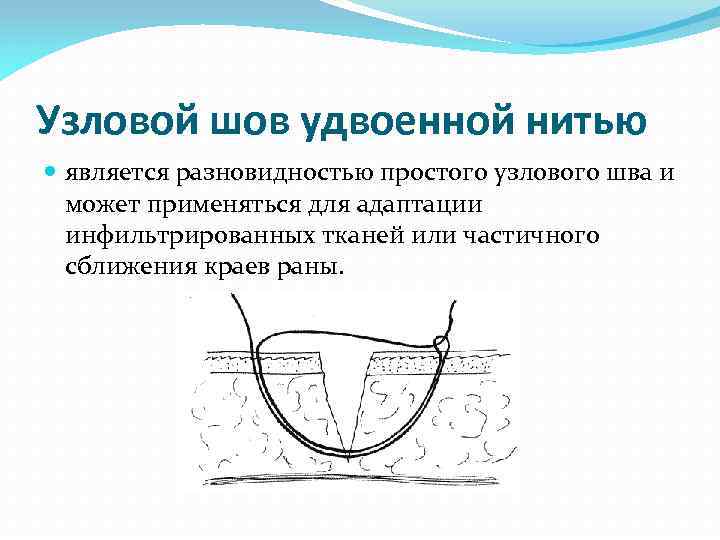 Узловой шов удвоенной нитью является разновидностью простого узлового шва и может применяться для адаптации