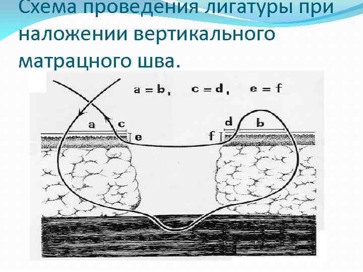 Схема проведения лигатуры при наложении вертикального матрацного шва. 