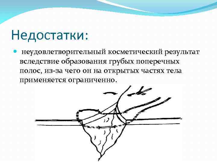 Недостатки: неудовлетворительный косметический результат вследствие образования грубых поперечных полос, из за чего он на
