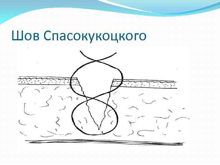 Шов Спасокукоцкого 