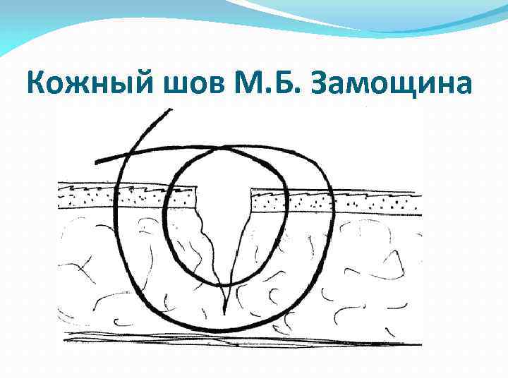 Кожный шов М. Б. Замощина 