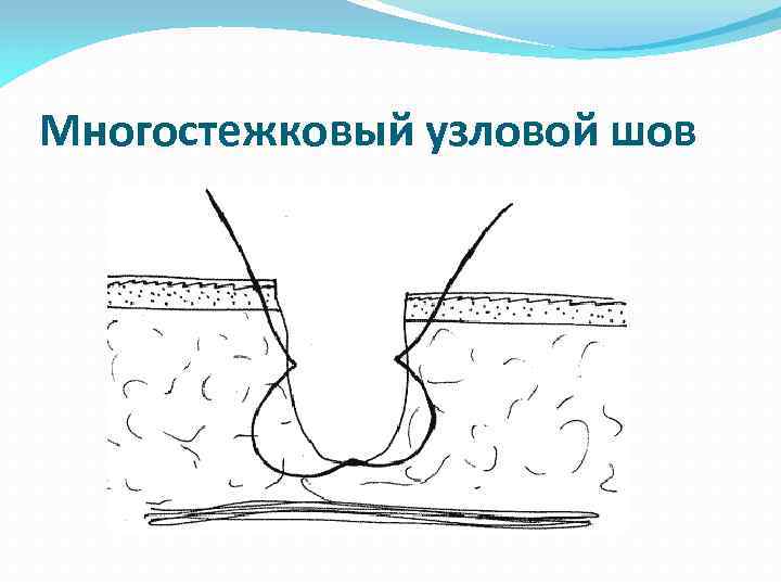 Многостежковый узловой шов 