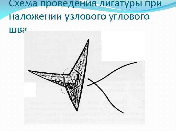 Схема проведения лигатуры при наложении узлового углового шва. 