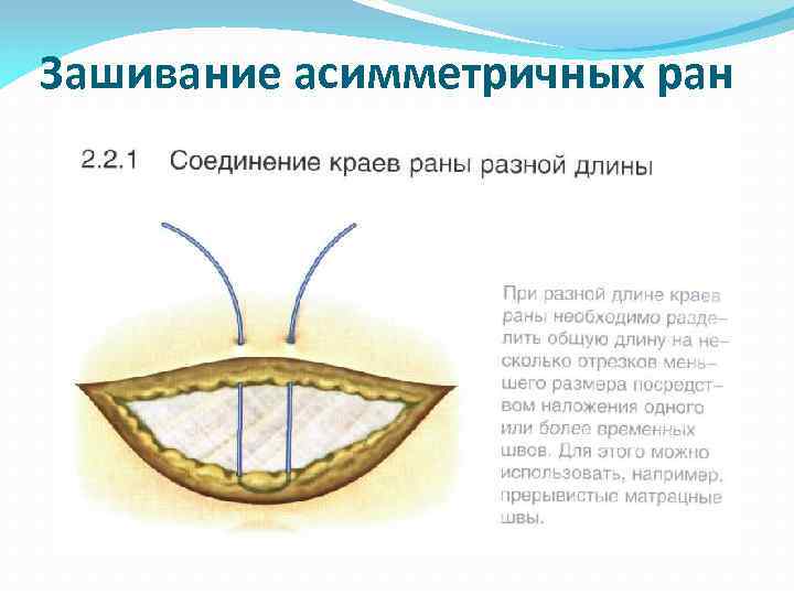 Зашивание асимметричных ран 