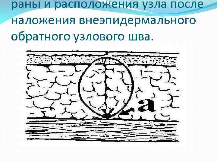 раны и расположения узла после наложения внеэпидермального обратного узлового шва. 