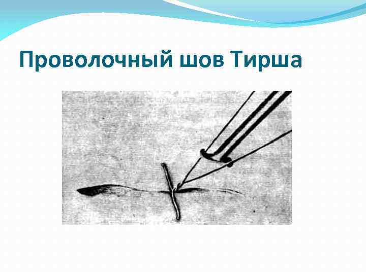 Проволочный шов Тирша 