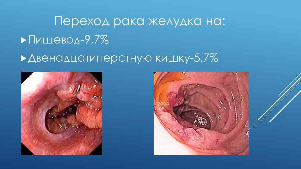 Переход рака желудка на: Пищевод-9, 7% Двенадцатиперстную кишку-5, 7% 