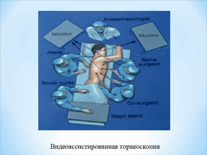 Видеоассистированная торакоскопия 