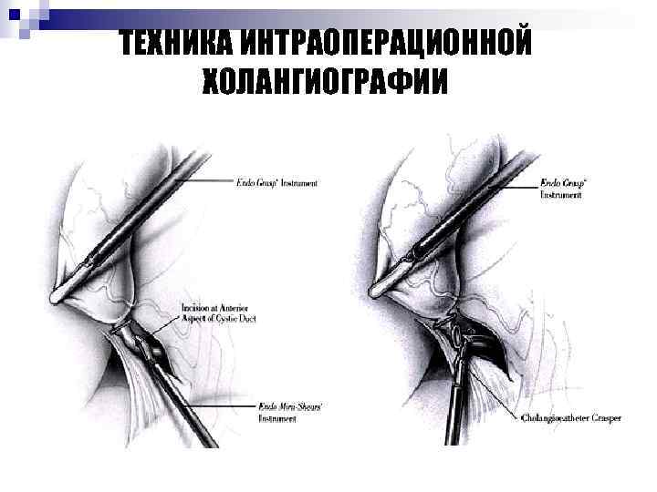 ТЕХНИКА ИНТРАОПЕРАЦИОННОЙ ХОЛАНГИОГРАФИИ 