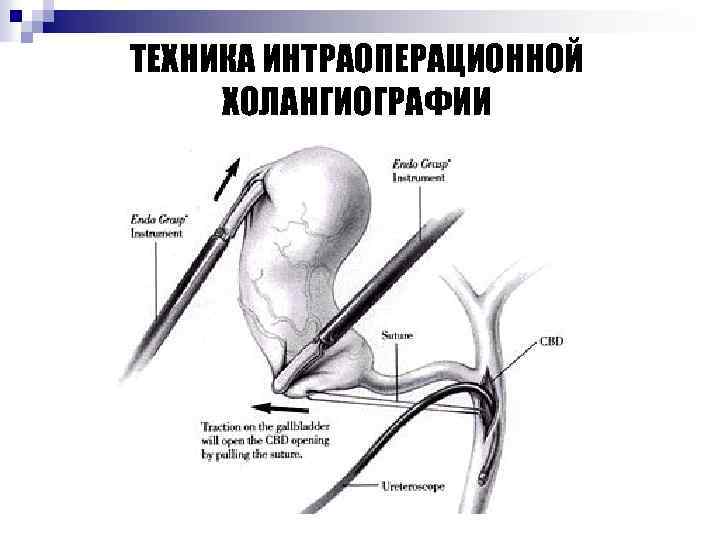 ТЕХНИКА ИНТРАОПЕРАЦИОННОЙ ХОЛАНГИОГРАФИИ 