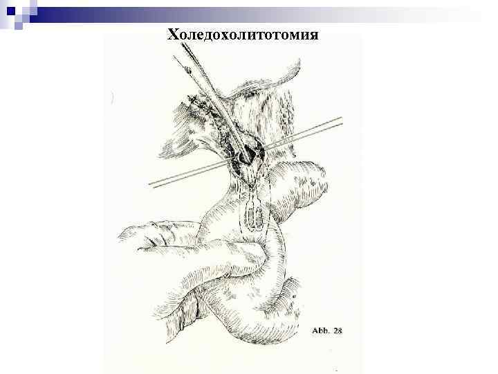 Холедохолитотомия 