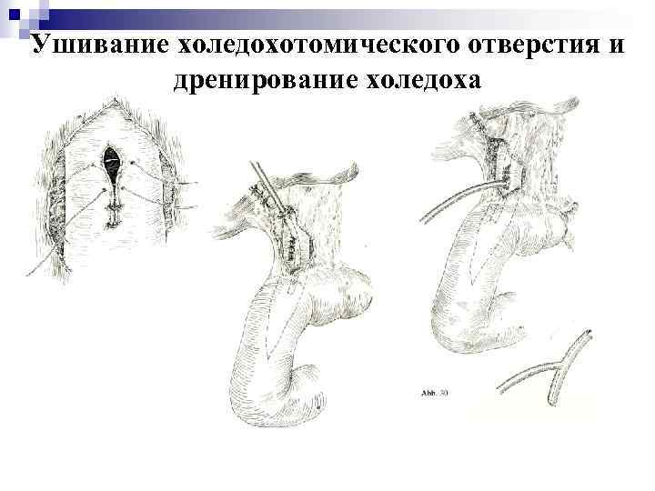 Ушивание холедохотомического отверстия и дренирование холедоха 