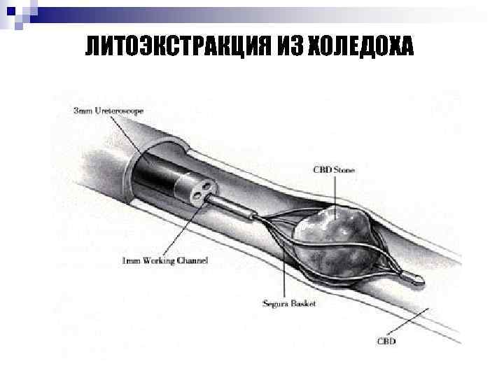 ЛИТОЭКСТРАКЦИЯ ИЗ ХОЛЕДОХА 