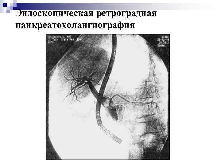Эндоскопическая ретроградная панкреатохолангиография 