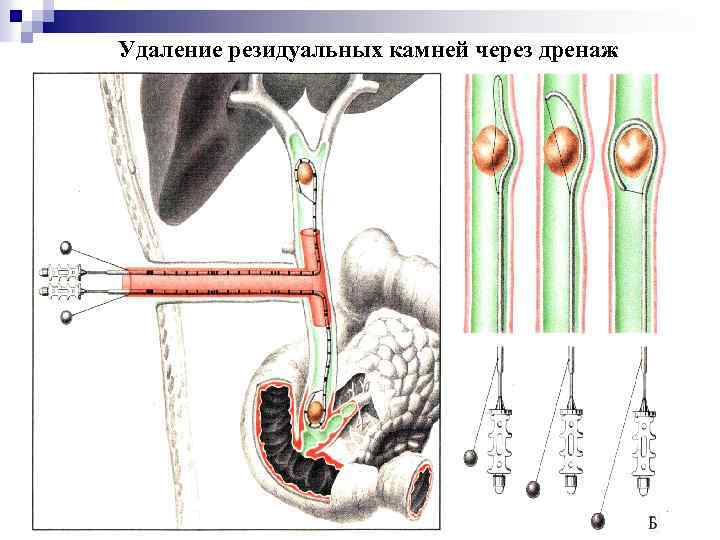 Постхолецистэктомический синдром презентация