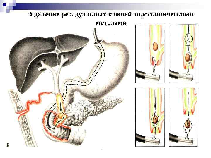 Удаление резидуальных камней эндоскопическими методами 