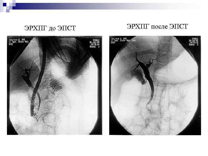 ЭРХПГ до ЭПСТ ЭРХПГ после ЭПСТ 